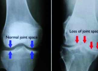 Osteoartrosi al ginocchio: come affrontarla?